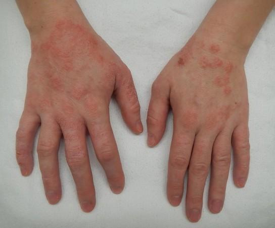 Dermatitis of the hands (Representational Picture) Dermatitis