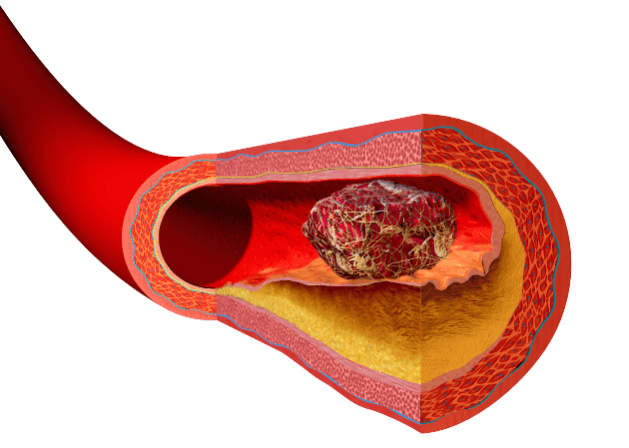 Blood Clot (Representational Picture) Blood Clot