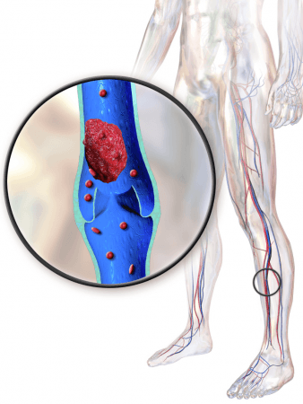Lower extremities deep vein thrombosis (Representational Picture) lower extremities deep vein thrombosis