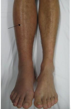 Deep vein thrombosis in the leg (Representational Picture) Deep vein thrombosis