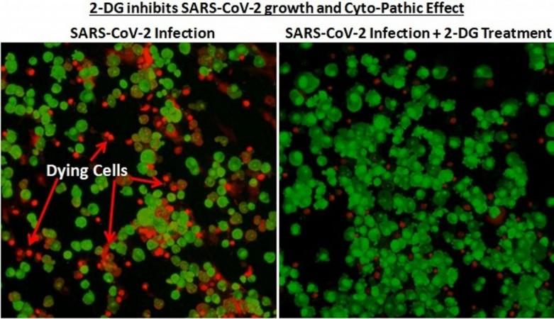 Inhibition of SARS-CoV-2 by 2-DG 2-DG coronavirus