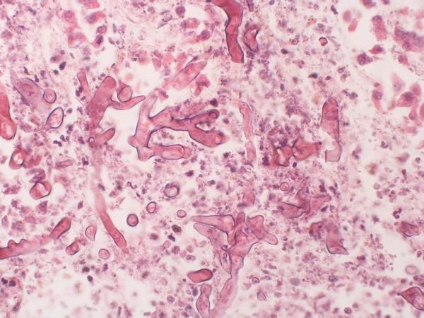 Mucormycosis (Representational Picture) Mucormycosis