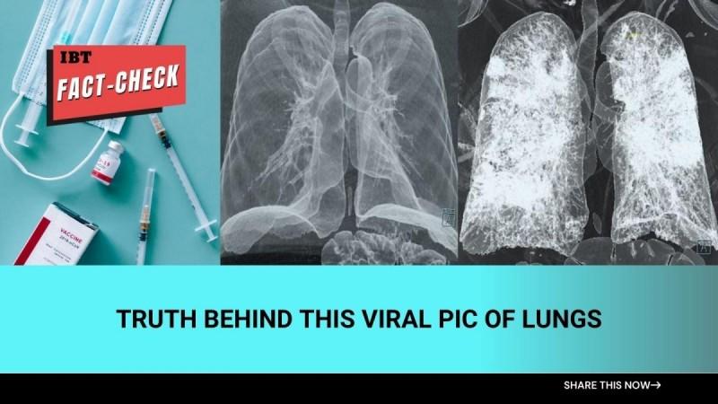 Fact check: Truth behind viral photo of CT scans comparing lungs of COVID and vaccinated patients