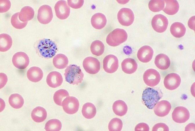 Malaria in Peripheral Blood (Representational Picture) Plasmodium Vivax