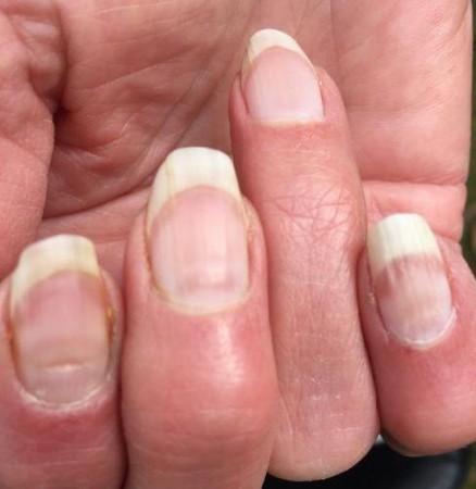 What are 'COVID Nails': Unusual symptom in COVID-19 survivors [should you  worry] - IBTimes India