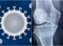 Covid arthritis
