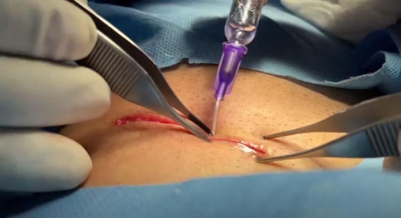 Sealing of a wound using a surgical glue (Representational Picture) Surgical Glue