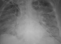 lungs