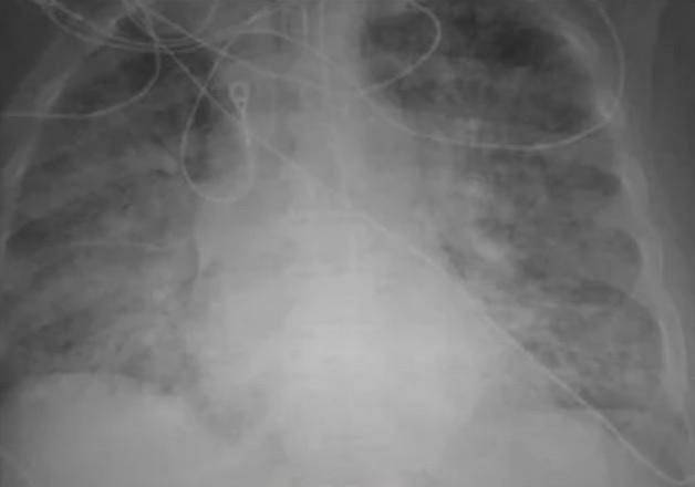 Lungs of an unvaccinated Covid patient lungs