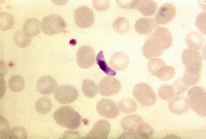 P. Falciparum in Peripheral Blood (Representational Picture) P. Falciparum