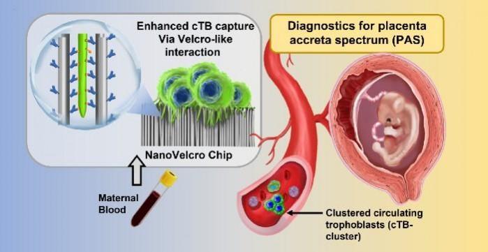 Graphic illustrating the non-invasive test for placenta accreta spectrum (PAS) disorder. The NanoVelcro Chip contains nanowires coated with antibodies that capture trophoblasts from the placenta found in the mother's circulation New TEst
