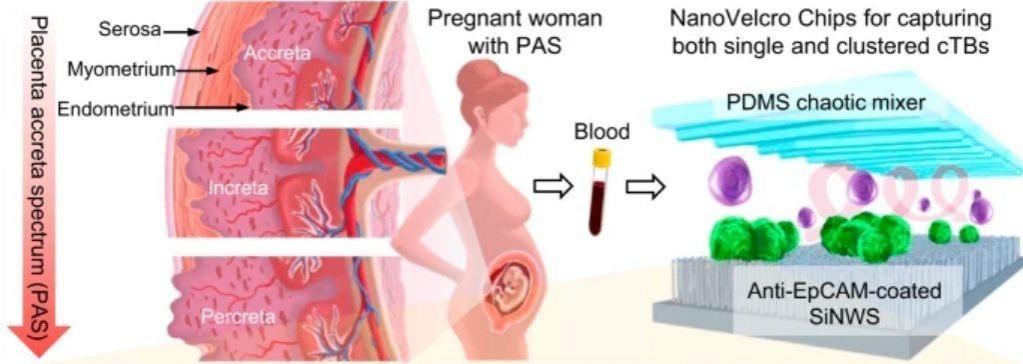 Abnormal invasion and adherence of placental trophoblasts into the uterine myometrium, classified into placenta accreta, increta, and percreta based on the severity of the disorder. During implantation and placentation, a small number of cTBs sheds from the placenta into the maternal circulation. NanoVelcro Chip, composed of an overlaid polydimethylsiloxane (PDMS) chaotic mixer and an anti-EpCAM-coated silicon nanowire substrates (SiNWS), was adopted to capture both single and clustered cTBs (colored in green) in maternal blood, allowing for noninvasive detection of PAS disorder. The trophoblast origin of the cTBs was confirmed by detecting trophoblast-specific genes and immunocytochemistry (ICC) staining on the captured cTBs New test