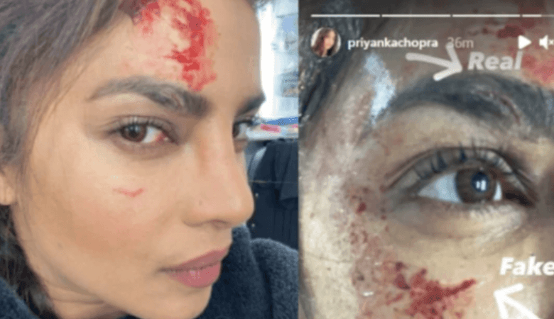 Priyanka Chopra injured