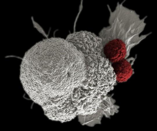 Cancer Immunotherapy, shown here is a pseudo-colored scanning electron micrograph of an oral squamous cancer cell (white) being attacked by two cytotoxic T cells (red) (Representational Picture) Immunotherapy