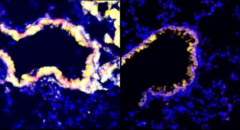 Immunofluorescent images of lungs treated with radiation (left) or no radiation (right). Club cells secrete more anti-immunosuppressive factors when treated with radiation, as seen by the increase in the secretory marker CC10 (yellow) Cancer Cell