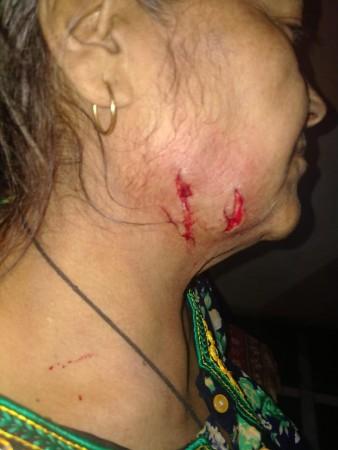 Images of Nirmala Singh who warded off the wild cat shared with IBT by wildlife conservationist Kishor Rithe Nirmala Singh sustained minor injuries from the leopard attack