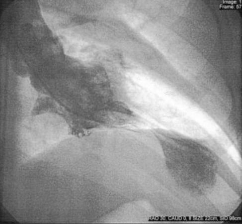 Takotsubo left ventriculogram (Representational Picture) Takotsubo ventriculography