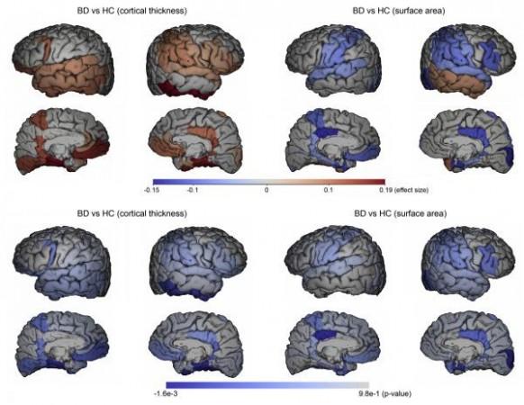 Effect sizes (Cohen's d; top) and significance of group differences (p-value; bottom) between BD patients and HC mapped into brain space. Cortical thickness findings (left) and surface area findings (right) are shown. The Figure displays the overall pattern in the uncorrected raw results. Positive effect sizes (warm red colors) represent BD > HC patterns (HC declines faster). Negative effect sizes (cold blue colors) represent BD < HC patterns (BD declines faster). Brain`