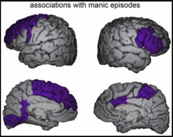 Anatomical location of brain regions listed in (purple) in which significant negative correlations between thickness change rates and the number of (hypo)manic episodes were observed. Mania