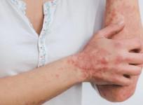 psoriasis