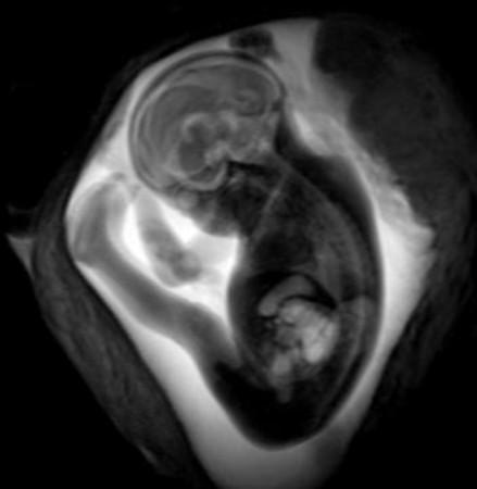 Image of one of the fetuses Mri