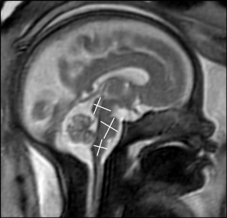 MRI of fetal brain development. MRI
