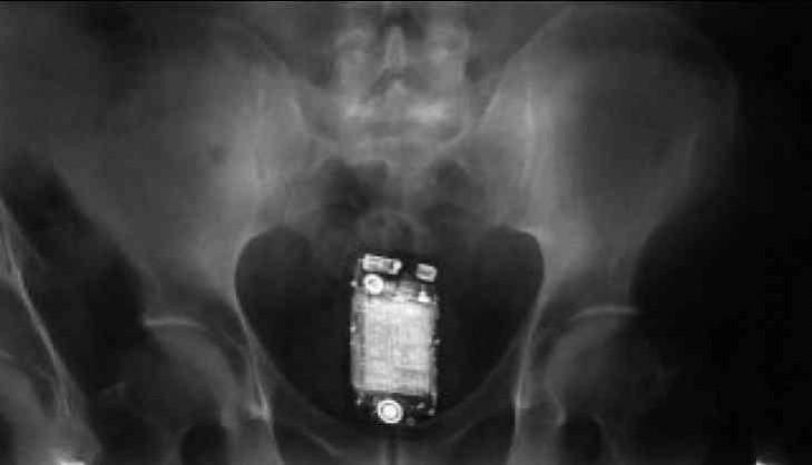 swallowed a mobile phone