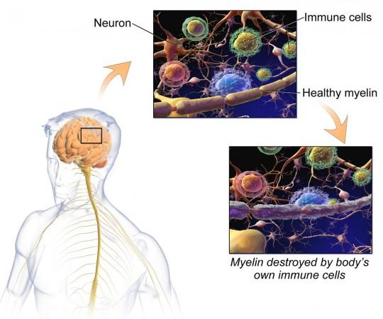 Multiple Sclerosis (Representational Picture) multiple sclerosis