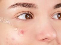 The importance of cleaning clogged pores
