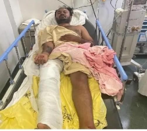 K'taka police shoot acid attacker in leg