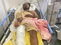 K'taka police shoot acid attacker in leg