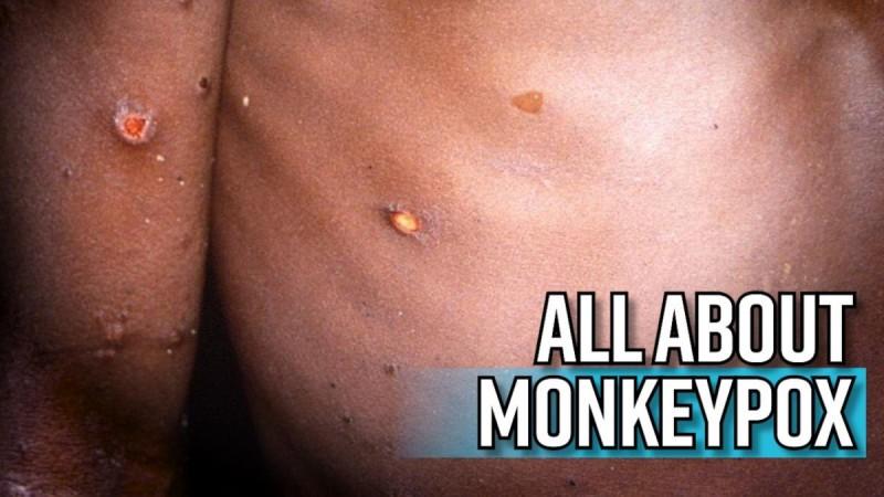 All about Monkeypox as Massachusetts reports first case in the US