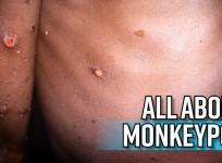 All about Monkeypox as Massachusetts reports first case in the US