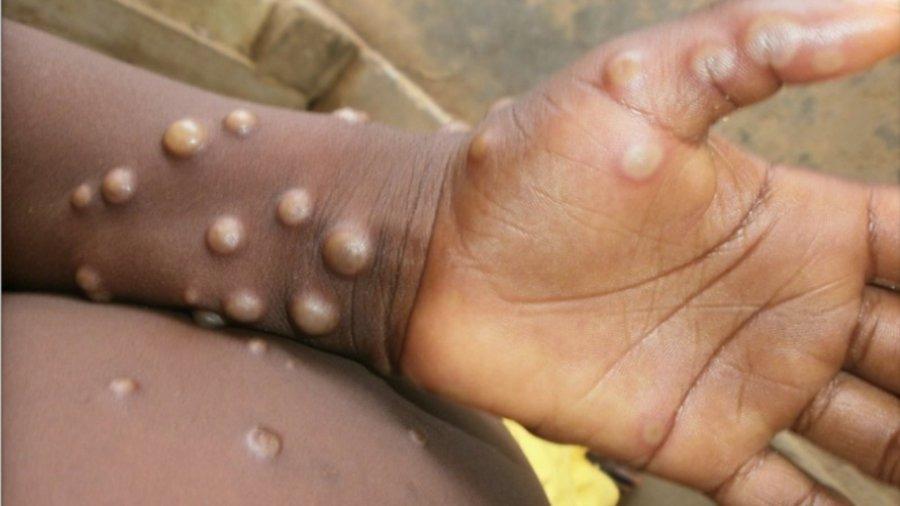 Netherlands confirms first monkeypox case; more cases to follow [details]