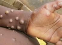 Monkeypox