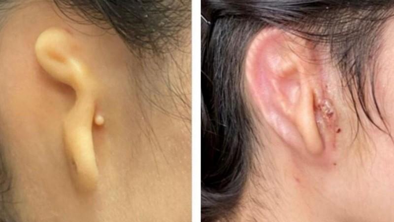 Woman implanted with 3D-printed ear made from her own cells.(photo:Microtia-Congenital Ear Institute and 3DBio Therapeutics) Woman implanted with 3D-printed ear made from her own cells.(photo:Microtia-Congenital Ear Institute and 3DBio Therapeutics)