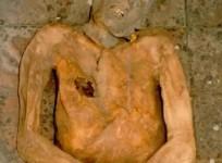 Ancient genome of E. coli reconstructed using gallstone of a 16th C mummy.(photo:Division of Paleopathology of the University of Pisa)