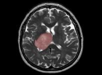 Brain cancer linked to tissue healing: Researchers