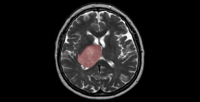 Brain cancer linked to tissue healing: Researchers Brain cancer linked to tissue healing: Researchers