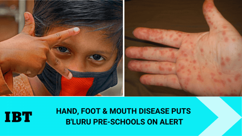 HFMD cases in Bengaluru HFMD cases in Bengaluru