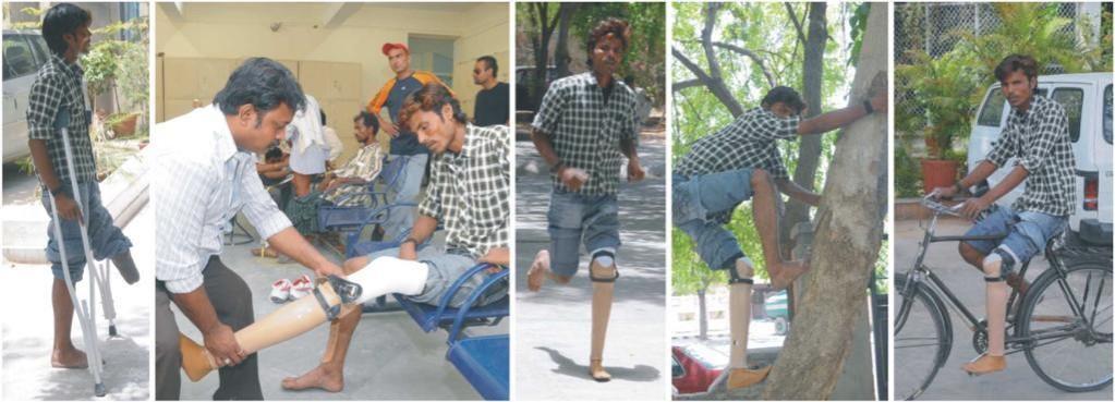 During a recent limb fitment camp in BMVSS HQ in Jaipur, a differently-abled youth came on crutches, but walked out with an artificial limb on the same day. Mega artificial limb fitment camp in Hyd; Jaipur Foot USA set to create history on I-Day