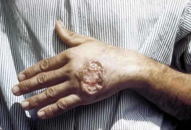 Leishmaniasis Leishmaniasis