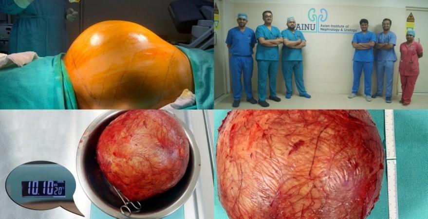 Doctors at Hyderabad hospital remove football-sized kidney tumour. Doctors at Hyderabad hospital remove football-sized kidney tumour.