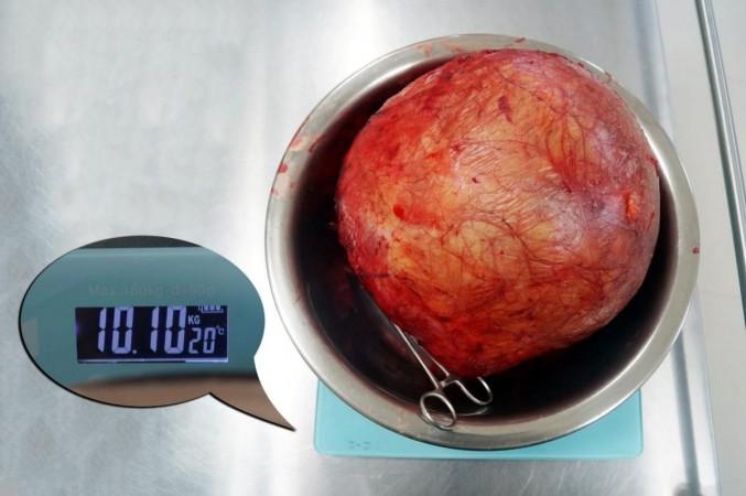 Doctors at Hyderabad hospital remove football-sized kidney tumour. Doctors at Hyderabad hospital remove football-sized kidney tumour.