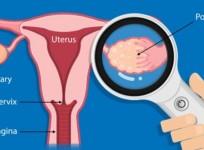 PCOS May Double Risk Of Ovarian Cancer After Menopause: Study
