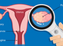 Hairdressers, Beauticians, Accountants At High Ovarian Cancer Risk: Study