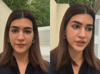 Kriti Sanon swollen face