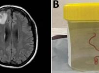 8-Cm Live Worm Removed From Woman's Brain In World's 1st Discovery