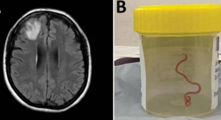 8-Cm Live Worm Removed From Woman's Brain In World's 1st Discovery 8-Cm Live Worm Removed From Woman's Brain In World's 1st Discovery