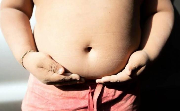 Obesity Obesity